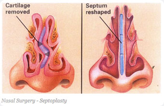 septoplasty