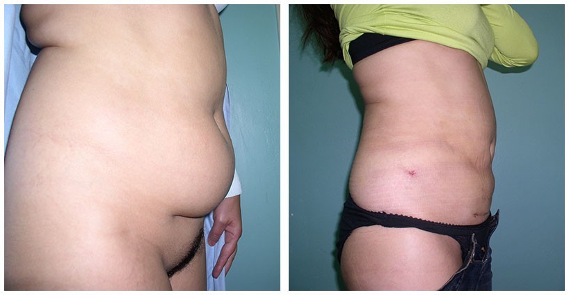 001-002-liposukcija